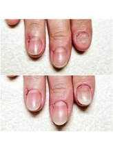 マニブルーム/深爪矯正/長さ出し