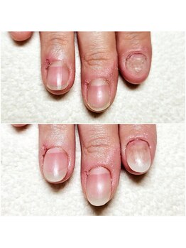 マニブルーム/深爪矯正/長さ出し