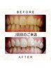 【自分磨きケア☆】2DAYSホワイトニング 8分×2回照射￥12,200→