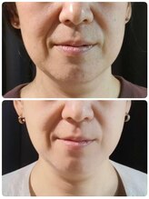 ラピスラズリ/ほうれい線にも【レモンボトル】