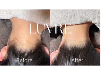 ルーヴレ(LUVRE)/うなじWAX脱毛