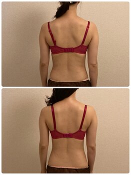 シエスタ(SIESTA)/筋膜ケア効果でスッキリ背中美人
