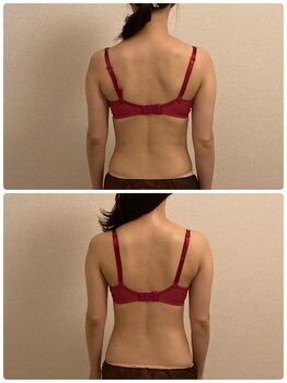 シエスタ(SIESTA)/筋膜ケア効果でスッキリ背中美人