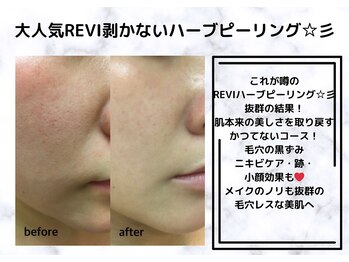 ルアナ 倉敷店(LUANA)/ニキビケア改善例