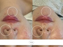 スワン 大阪南堀江(swan)/お肌の色むらや赤みにお悩みの方