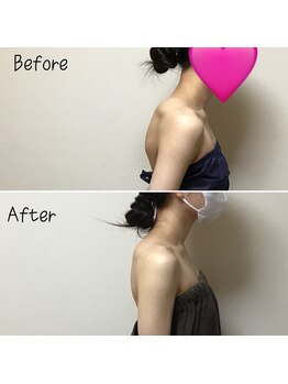 アルディート(Ardito)/肩甲骨はがし