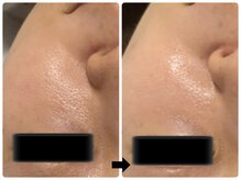 エフェクト 塚口店(effect)/Before After &nbsp;&nbsp;30代/2回目