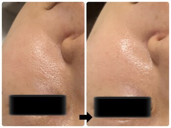 エフェクト 塚口店(effect)/Before After 30代/2回目