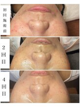 ブラックボックス(BLACK BOX)/ハーブピーリング3回+陶肌ピール