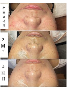 ブラックボックス(BLACK BOX)/ハーブピーリング3回+陶肌ピール