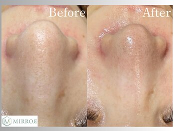 ミラー(MIRROR)/熊本市/毛穴洗浄/西熊本/くすみ