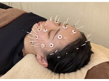レガロ/美容鍼灸やってます！