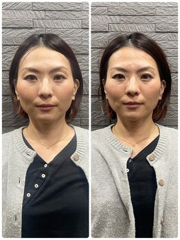 長寿鍼灸院 長寿整骨院/美容鍼50本の効果★小顔効果