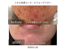 マインエム(mine.m)の雰囲気（《オーダーメイド肌管理》で繰り返すニキビ・跡も根本改善）