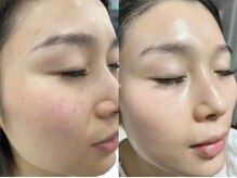 ナラビューティー(NARA BEAUTY)/韓国肌管理！ララピール