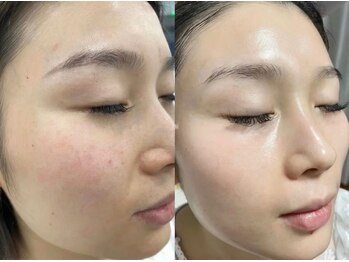 ナラビューティー(NARA BEAUTY)/韓国肌管理!ララピール