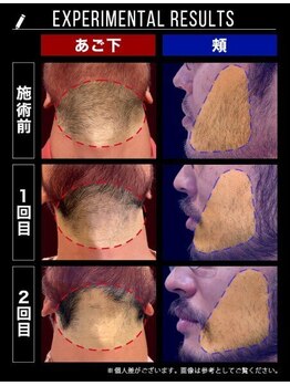 RBL 三宮店/メンズ脱毛/ヒゲ脱毛施術2回目