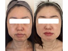 エムズサロン(m’sサロン)/初回→12回のビフォーアフター