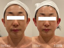 ユーフォリア グロウ(euphoria glow)/｛ &nbsp;小顔フェイシャル 3回 &nbsp;｝