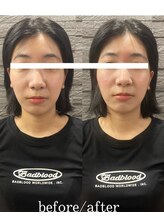 長寿鍼灸院 長寿整骨院/美容鍼25本の効果★リフトアップ