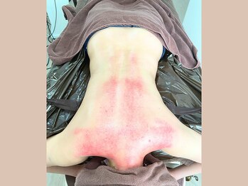 リライブ 亀有店(Re:Lives)/吸引ビフォーアフター【痩身】