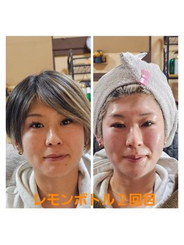 アン 銀座(ann)/レモンボトル2回目