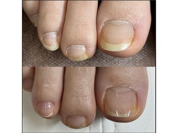 リリ(lili)/フットネイルスキンケア2回目