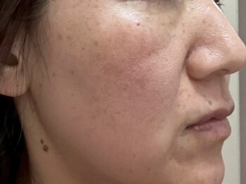ククル(KUKULU)の写真/【続けやすいエイジングケアならコレ！】ハーブピーリングで自己ケアでは難しいほうれい線/たるみケアを♪