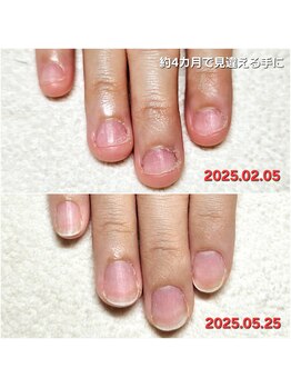 マニブルーム/深爪矯正