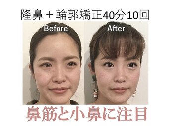 ラプリ 梅田店(Raplit)/隆鼻＋輪郭矯正40分10回