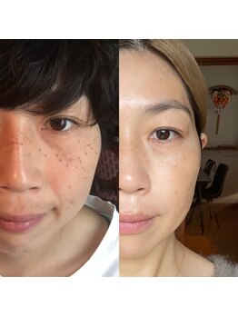 サロンドウルス(salon de ours)/エクソソーム