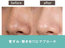 ココミエレ(COCO MIELE)/毛穴洗浄ビフォーアフター