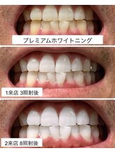 エクシアホワイト SOKA(ecxia white)/