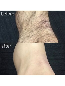 スイッチプラス(switch plus)/-足脱毛-