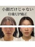 【6月末迄】《フルコース》整体＆美容鍼＆小顔矯正 150分 ¥30000→￥23000
