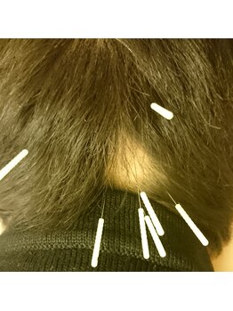 はり灸心音/部分脱毛の場合-頭鍼比較