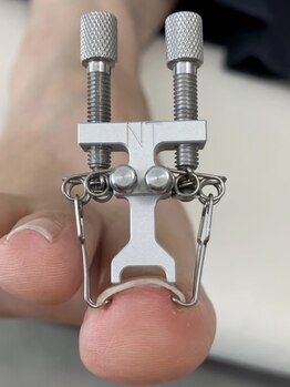 ロンディネ(Rondine)の写真/【サンダルを履く季節♪】足の巻き爪・分厚い爪・爪の剥離から自慢できる健康的な足もとへ◎