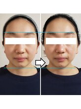 きしの美容整体院/フェイシャルリフトケアBA