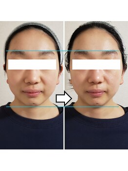 きしの美容整体院/フェイシャルリフトケアBA