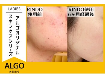 アルゴ 越前店(ALGO)/スキンケアを半年使用すると…