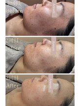 アルム(Areum)/カーボキシーの力♪