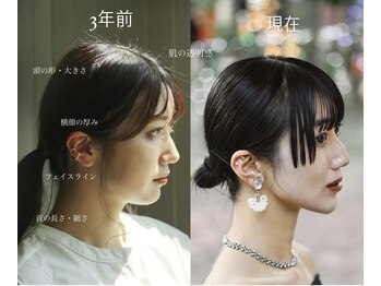 スノードロップ(snow drop)/snow drop式 小顔骨格矯正