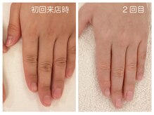キレイテ 上野店/30代/2回目【東京ハンドケア】