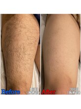 ファビー(Fabby)/メンズ脱毛★もものビフォアフ