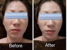 モンシェリ/小顔矯正一回施術