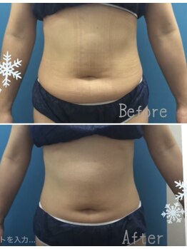 プリマプリート 各務原店/脂肪冷却4CUP！