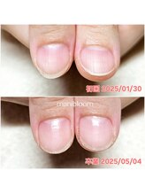 マニブルーム/深爪矯正