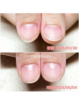 マニブルーム/深爪矯正