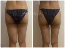 エルール トータルビューティ(Aileure total beauty)/術後ケア　太もも