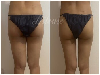 エルール トータルビューティ(Aileure total beauty)/術後ケア 太もも